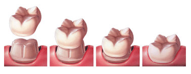 Dental crown attached to a old tooth